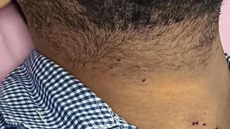 RTI से बड़ा खुलासा: 20 जुलाई को जंतर-मंतर Protest में Pellet Injuries से 10 लोग घायल