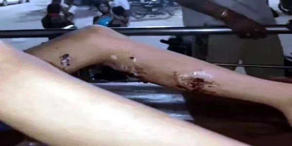 फरीदाबाद में पिटबुल कुत्ते का खौफ: सातवीं के छात्र पर हमला कर शरीर पर 16 जगह काटा, पुलिस जांच शुरू